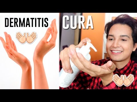 Cosmetici da dermatite atopic Devyasit unerba allatto di cura di psoriasi