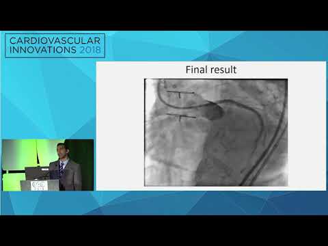 CVI2018 Session: The dreaded old vein graft - Arslan Shaukat