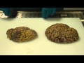 (ei heikkohermoisille) Alzheimer's brain dissectio...