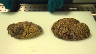 Alzheimer&#39;s brain dissection