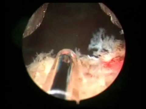 Vaporisation laser de la prostate - Partie 2