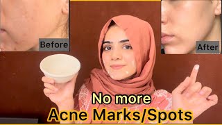 How To Remove Acne Marks Or Spots | Best Easy Home Remedy For Acne | Dietitian Aqsa
