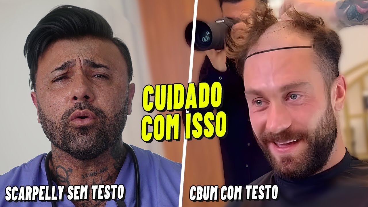 COMO NÃO FICAR CARECA USANDO TESTOSTERONA? Doutor Scarpelly