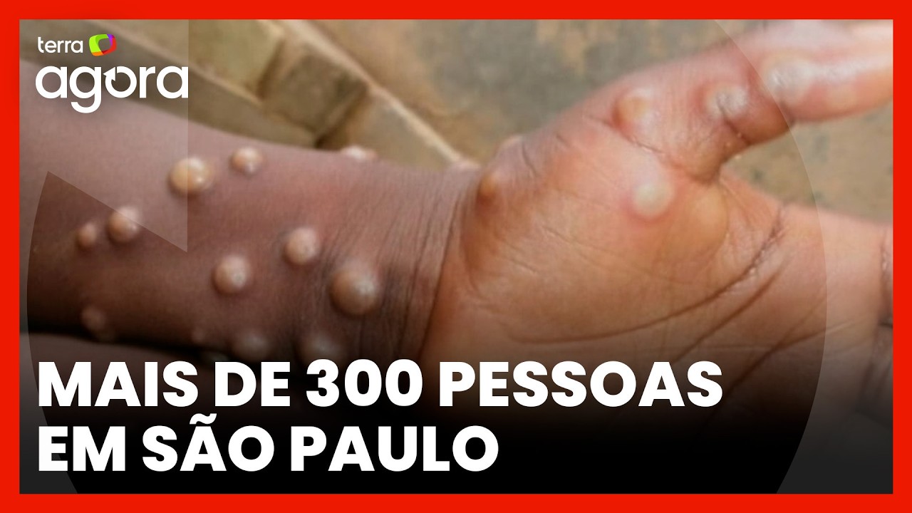 MPOX: Entenda a diferença entre doença presente no Brasil e nova variante mais letal