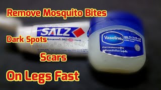 Only 2 days!! How To Remove Mosquito Bites Scar, Dark Spots, Hyperpigmentation On Legs Fast