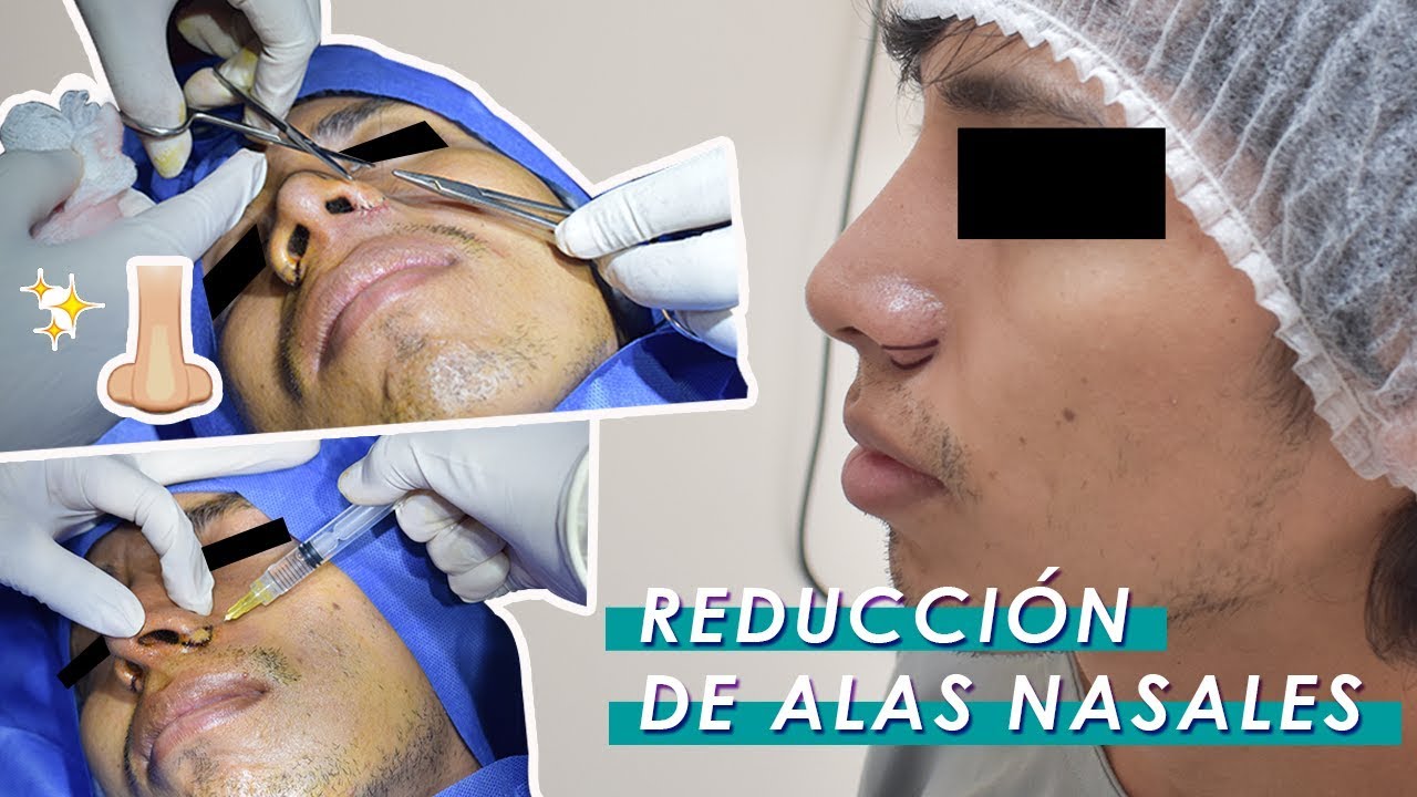 Watch Reducción de Alas Nasales (Nariz grande) - Dr Cesar Calderon Cirujano Plastico - Trujillo Peru Now Reducción de Alas Nasales (Nariz grande) - Dr Cesar Calderon Cirujano Plastico - Trujillo Peru