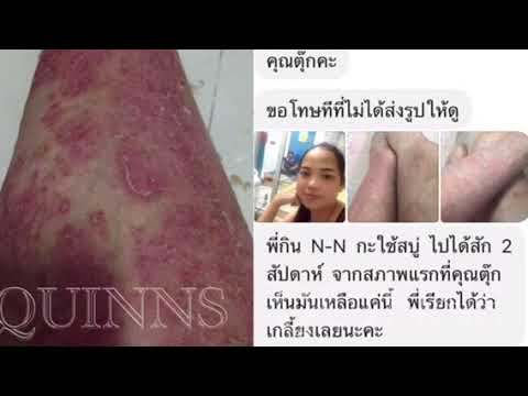 Diprosalik ช่วยโรคสะเก็ดเงิน จมูกกลาก