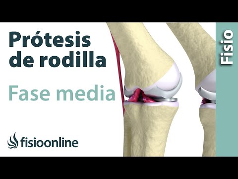 Ejercicios y tratamiento de rehabilitación para una prótesis de rodilla - segunda fase