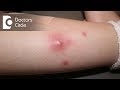 Diagnosis And Management Of Boil On Buttock Area Dr Rasya Dixit