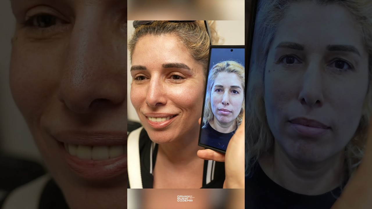 Üst Göz Kapağı Operasyonu 1.Ay Kontrolü #gözestetiği #üstgözkapağı #estetikcerrahi