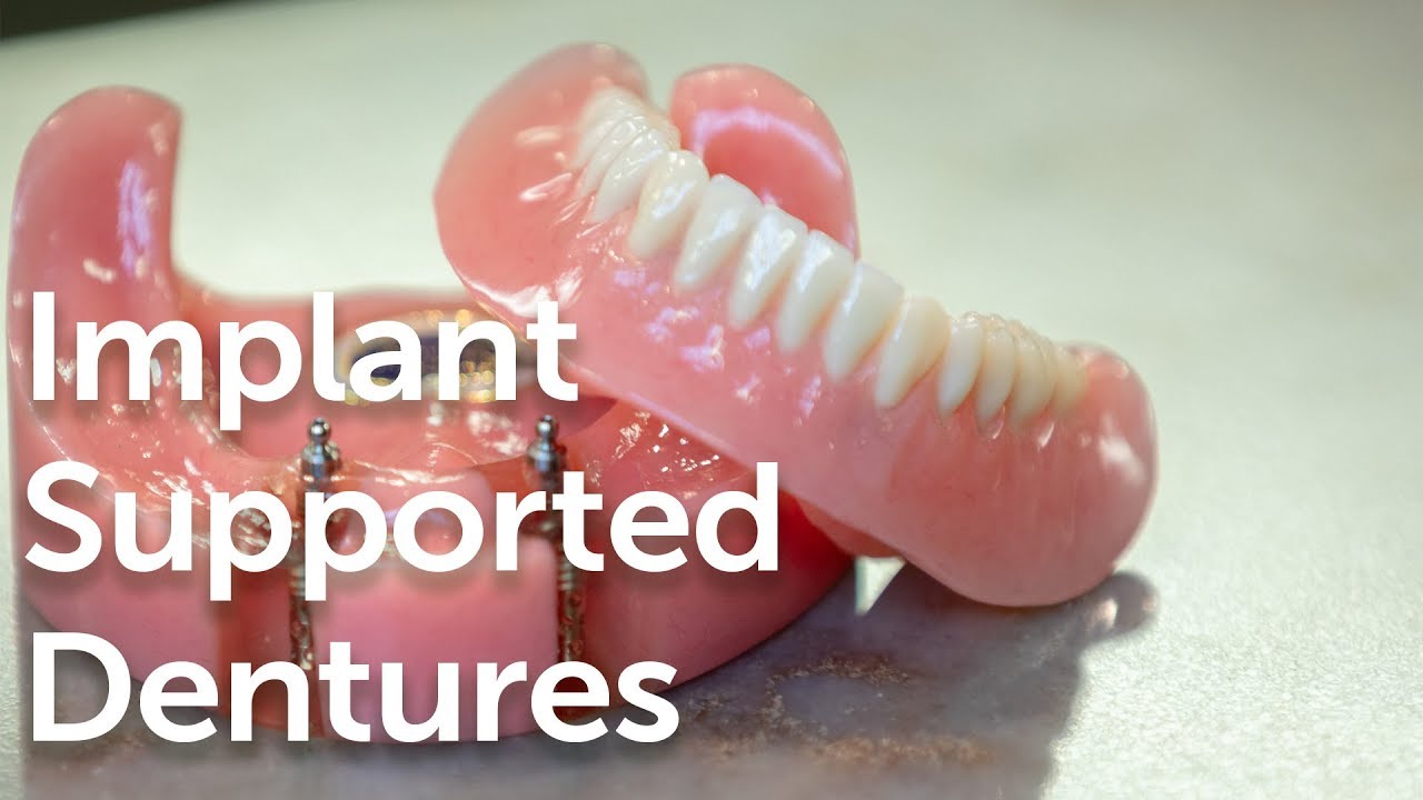 Implant supported dentures explained