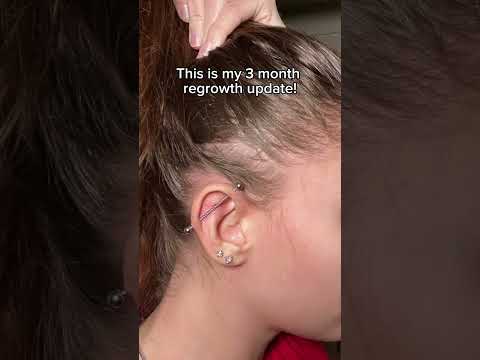 The most effective hair regrowth product - KilgourMD