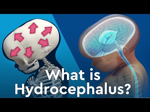 Born Behind The 8-Ball | Living with Hydrocephalus & Hypotonia