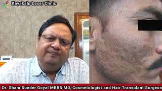 Combination Treatment for Acne Scar | Laser Treatment | Rajasthan Patient