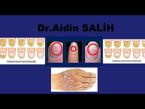 Dr.Aidin SALİH''Tırnakta Mantar En Çok Sedef Hastalıklarında Olur/Yada Olacak Mesajı Verir''