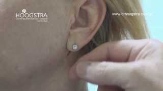 Lóbulo de las orejas, cierre del orificio (14007)