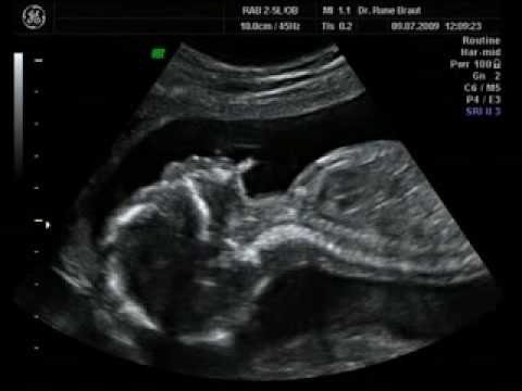 Ultraljud 19 veckor