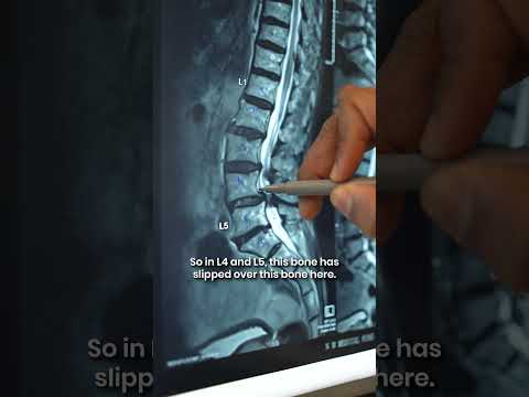 MRI of Spondylolisthesis: What Does It Look Like? | Dr. Ajay Kothari