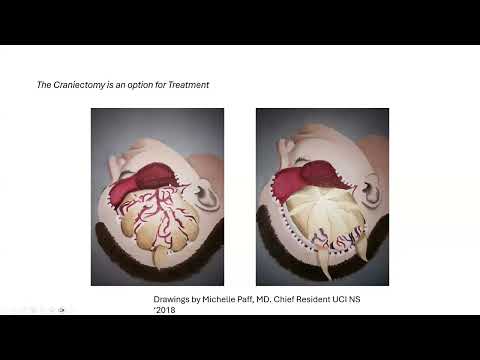 Session 2: Surgical Interventions in Hemorrhagic Stroke: Evidence and Insights