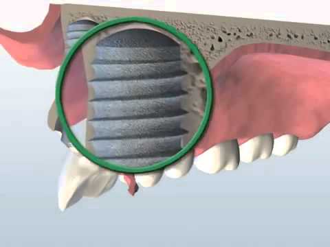 London - Tooting - Dental Centre - Dental Implants