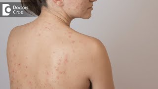 Tips to deal with Back Acne - Dr. Swetha Sunny Paul