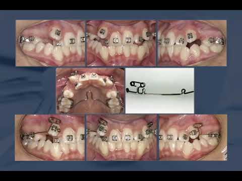 A simple approach to correct ectopic eruption of maxillary canines