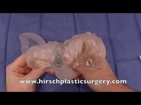 1st YouTube video about what are gummy bear implants