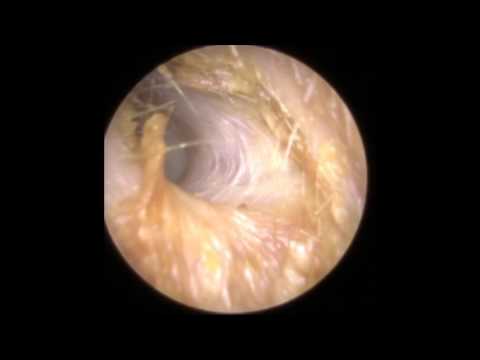 Ear Wax Removal using Jobson Horne in Narrow Ear - Mr Neel Raithatha (The Hear Clinic)