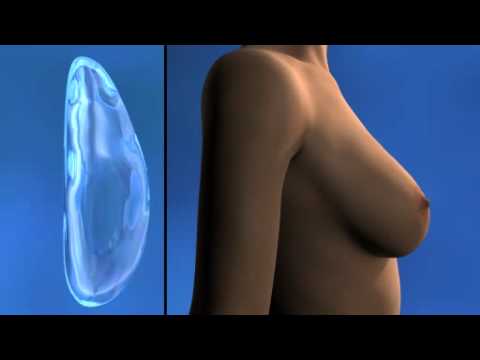 comment augmenter poitrine