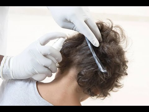 Mayo Clinic Minute - Debunking head lice myths