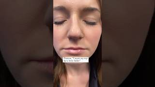 Lip Filler For Thin Lips