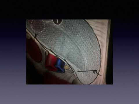 Lichtenstein-Amid Hernia Repair