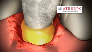 Watch as ATRIDOX® is applied for treatment of chronic adult periodontitis - DenMat Dental Products