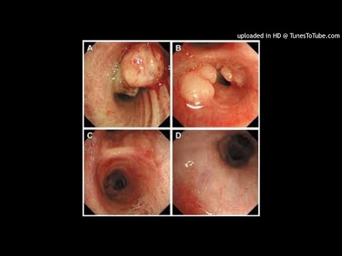 Prognostic factors in the outcome of NUT midline carcinoma