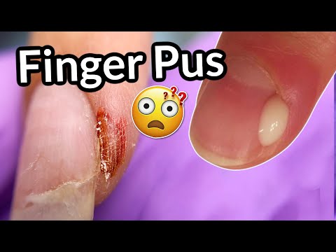 Infected Finger After Nail Salon 😱 WHY did it happen? | Paronychia