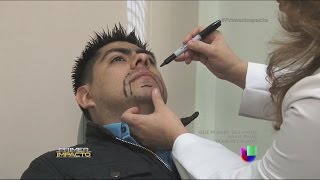 Cada vez más hombres optan por trasplantarse barba y bigote