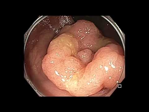 Colonoscopia - RME de pólipo rectal - resección de pólipo sésil grande