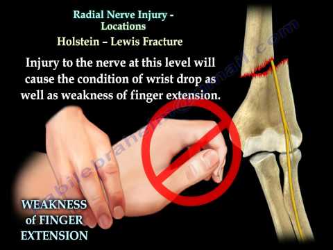 Radial Nerve Injury, Locations - Everything You Need To Know - Dr. Nabil Ebraheim