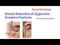 Closed Reduction of Zygomatic Complex Fractures | Oral & Maxillofacial Surgery | Syed Amjad Shah