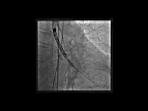 Evolut R Implantation