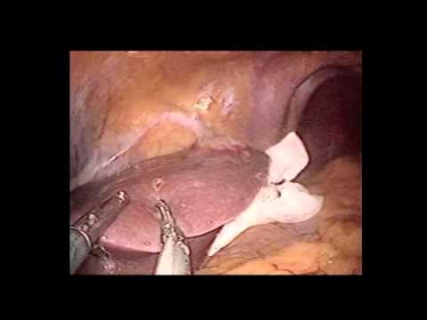 Single-Port Laparoscopic Hepatectomy