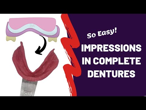 Theories of Impression Making in Complete Dentures