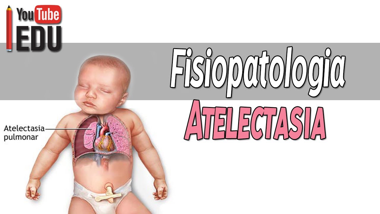 Atelectasia │ Fisiopatologia