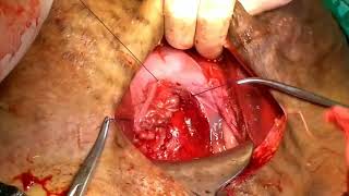 Caesarean section with twins