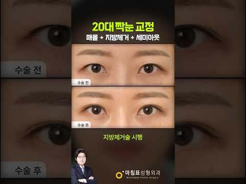 20대 여성의 짝눈 교정 · 韩语