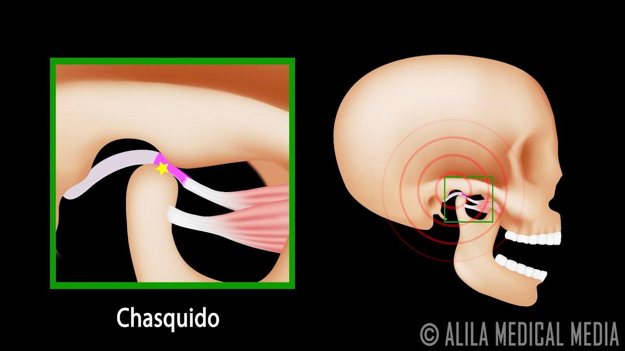 ATM - Articulación Temporomandibular y Desplazamiento Discal. Alila Medical Media Español.
