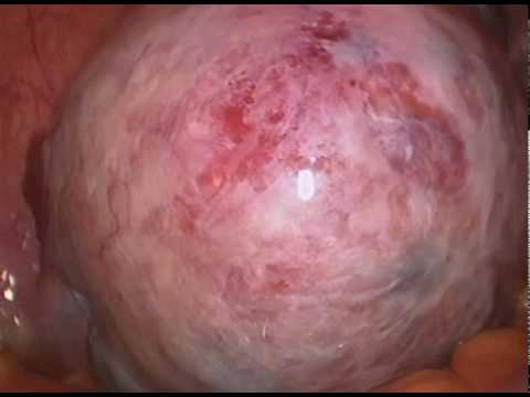 Single-Port Laparoscopic Removal of an Ovarian Tumor