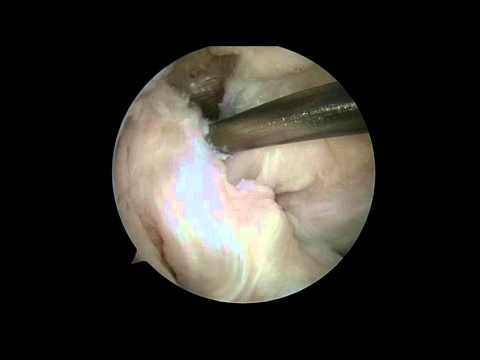 Posterior Cruciate Ligament Correction Using Remnant Augumentation Technique