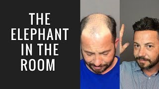 Hair Replacement Mens Hair System Review The Elephant in the Room !
