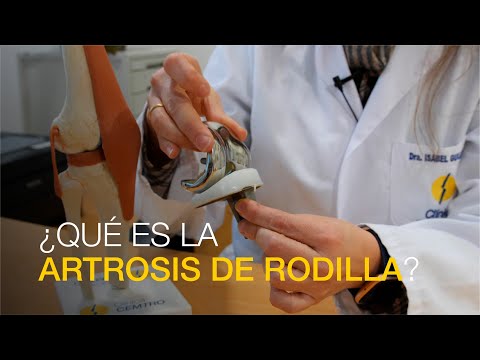 ¿Qué es la artrosis de rodilla?